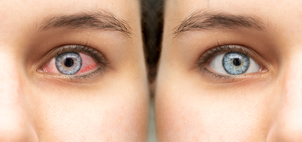 ojo antes y despues de conjuntivitis