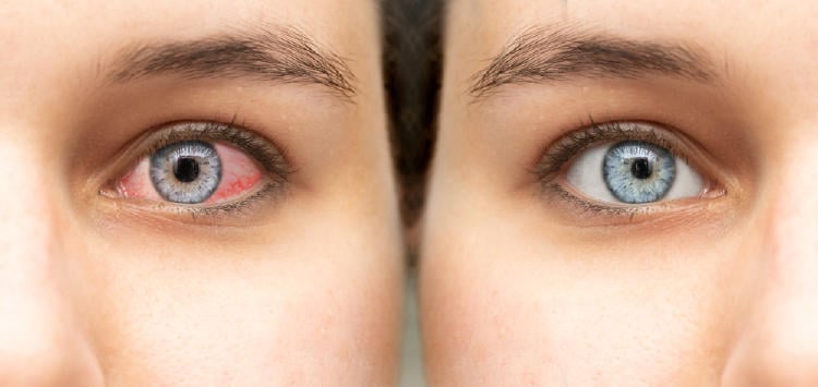 ojo antes y despues de conjuntivitis