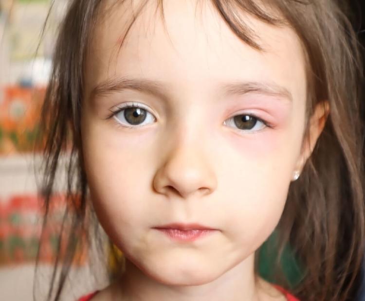 angioedema del tipo hereditario en niño