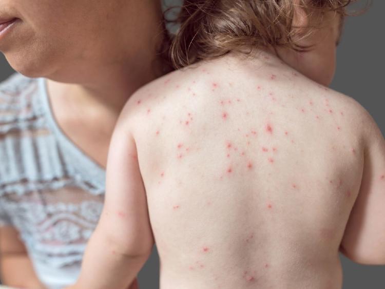 varicela y herpes zoster varicela y herpes zoster