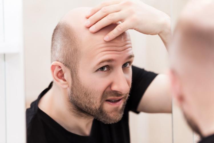 alopecia irreversible