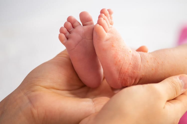 madre sosteniendo los pies de un bebe con dermatitis atópica