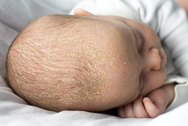 dermatitis cuero cabelludo bebe