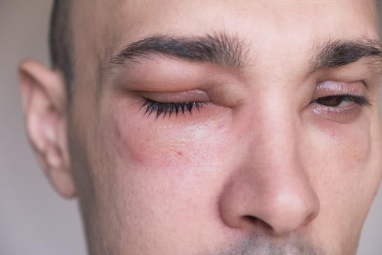 angioedema alrededor de los ojos