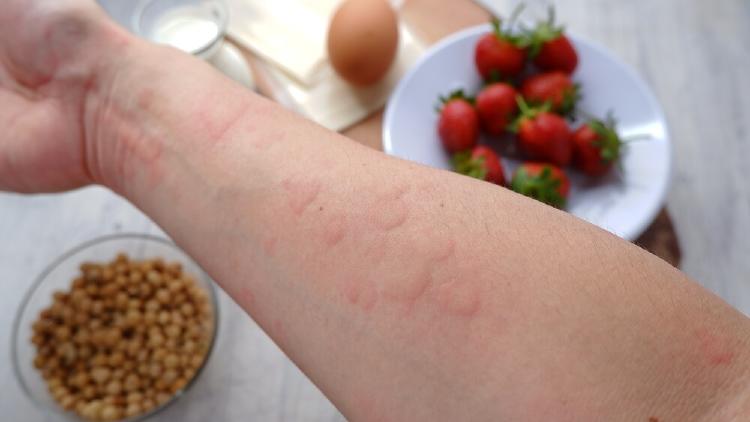 brazo con urticaria alimentaria