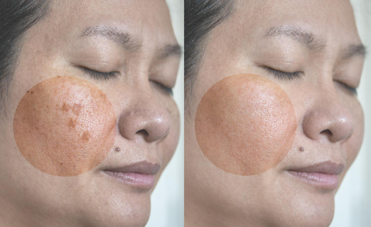 imagen comparativa de un rostro con mancha solar y el otro rostro con melasma