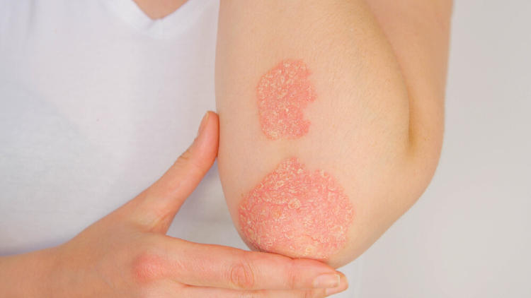 piel con psoriasis