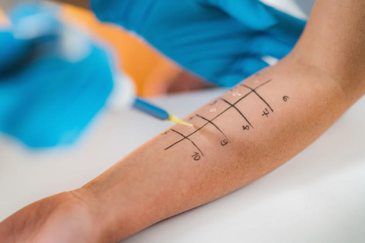 brazo extendido de una persona haciéndose una prueba de prick test